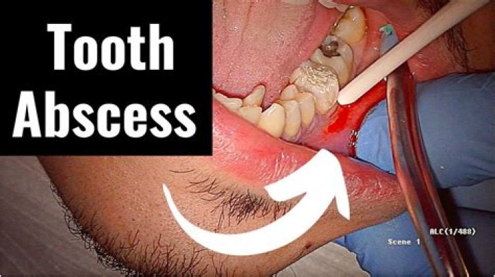 Are abscessed teeth deadly?
