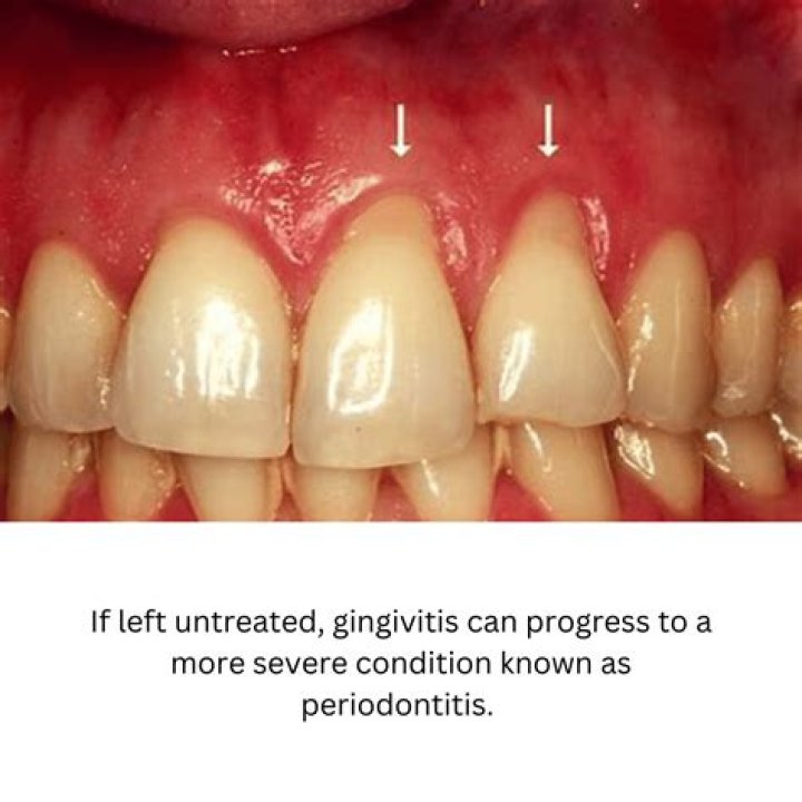 Are is gingivitis curable?