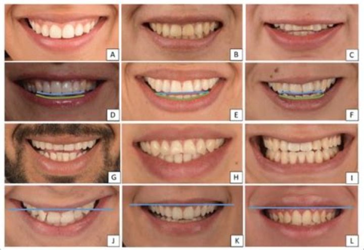 Are lopsided smiles attractive?