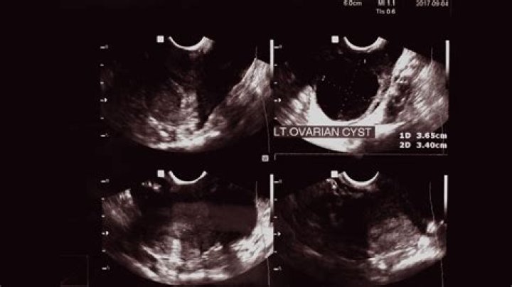 Are ovary cysts common?
