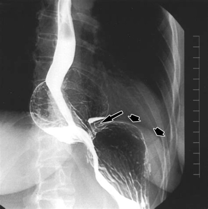 Can a toupet fundoplication be reversed?