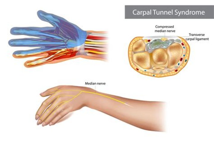 Can carpal tunnel cause elbow pain?