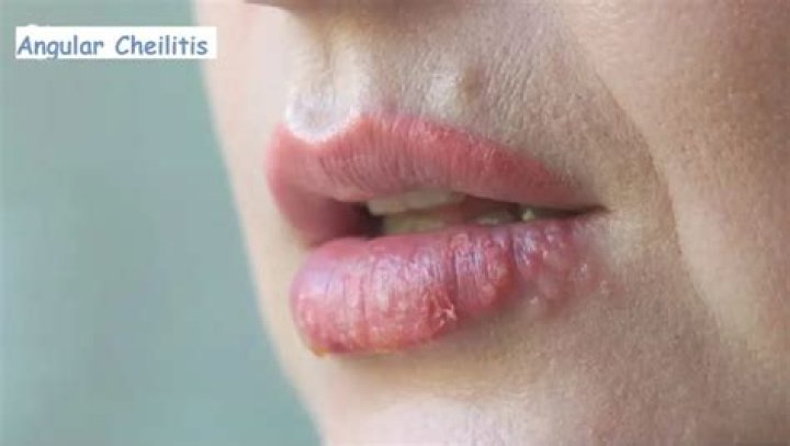 Can cheilitis cause blisters?