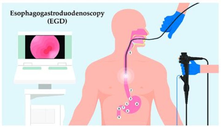Can esophagogastroduodenoscopy detect cancer?