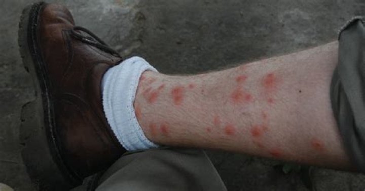 Can flea bites spread from scratching?