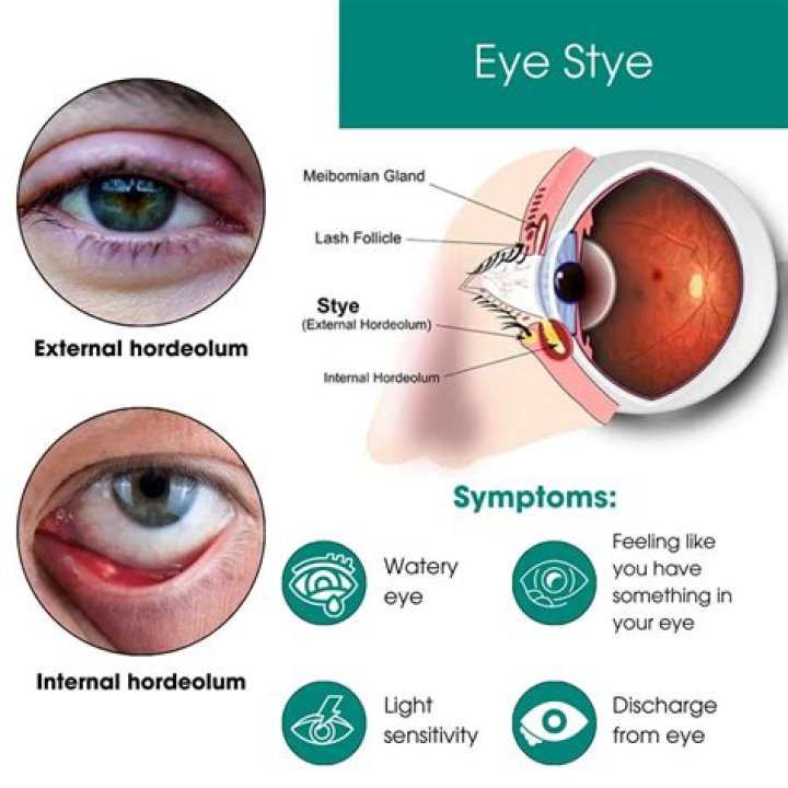 Can i pop a stye on my eyelid?
