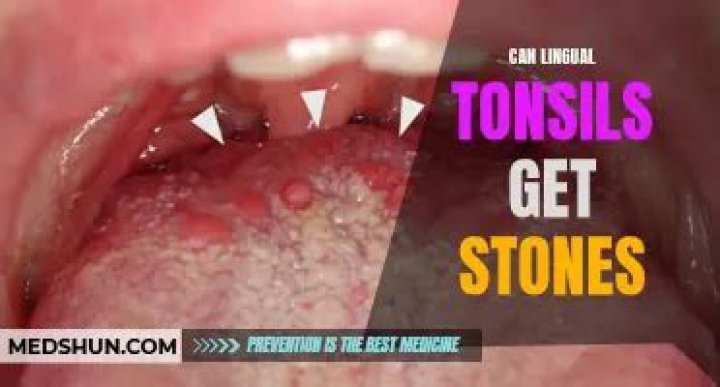 Can lingual tonsils get stones?