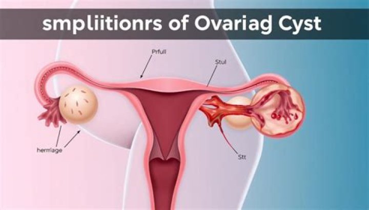 Can ovarian cysts cause leg ache?