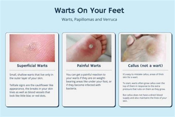 Can warts go away on their own?