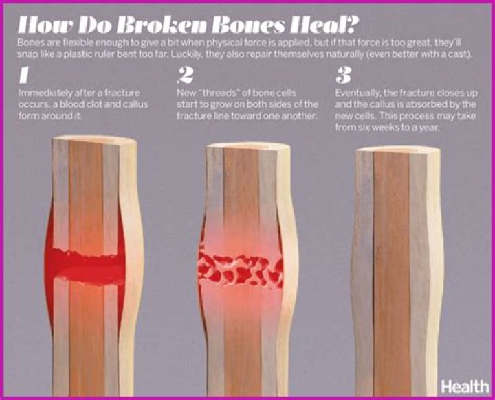 Can you break a bone and not realise?