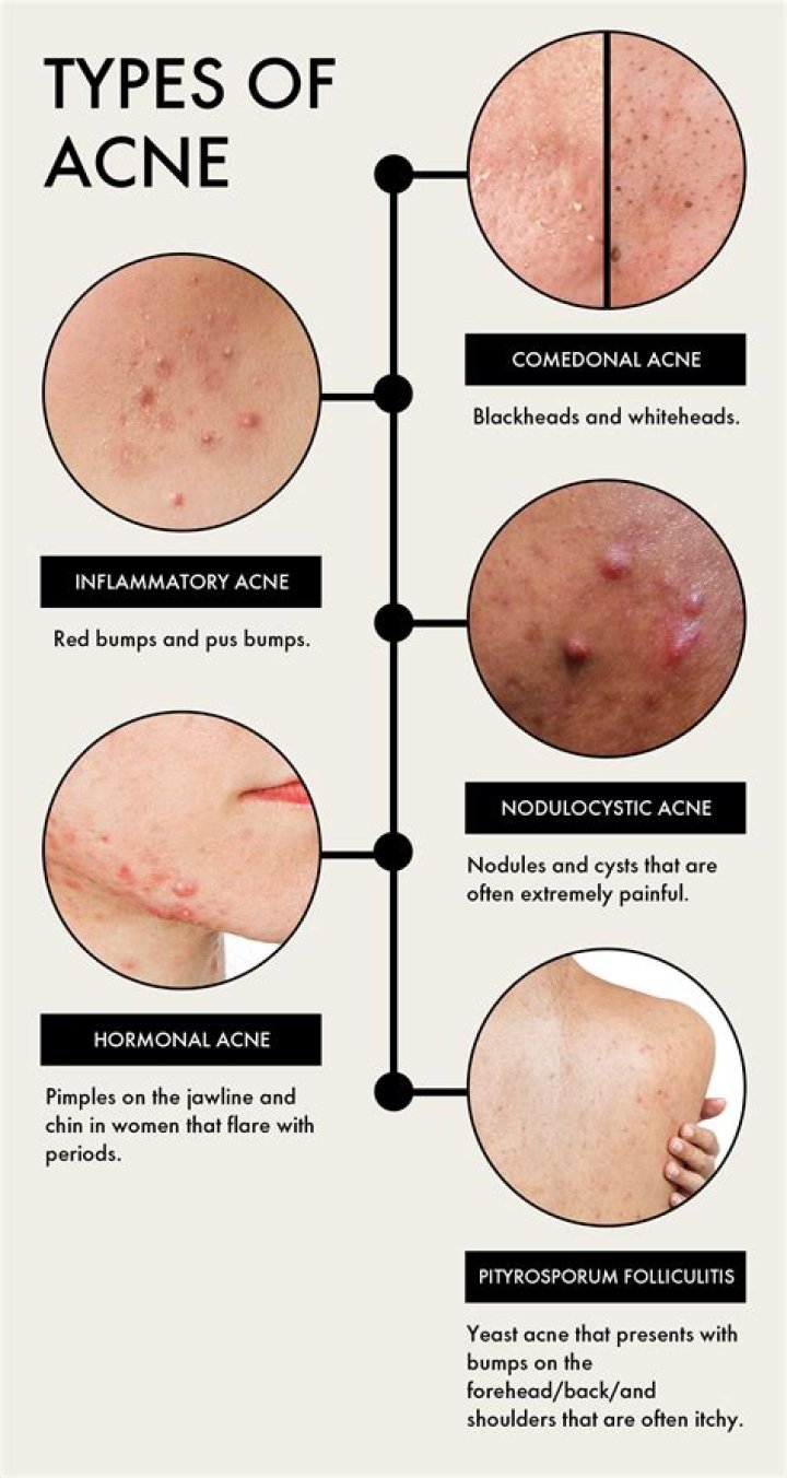Could sleep be causing my acne?
