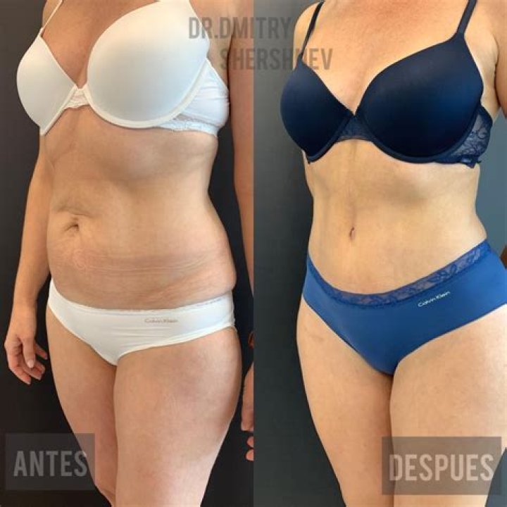 ¿Cuánto cuesta una lipoescultura sin cirugía en México?