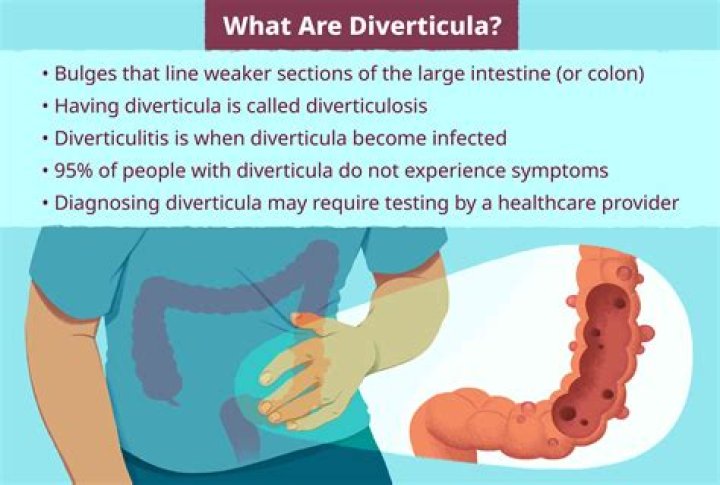Do diverticula cause gas?