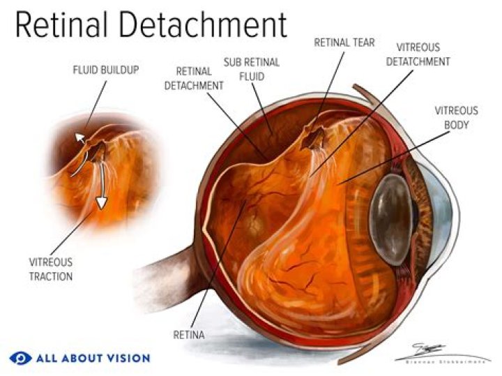 Do retinal holes heal on their own?