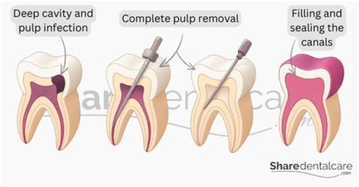 Does a pulpectomy hurt?