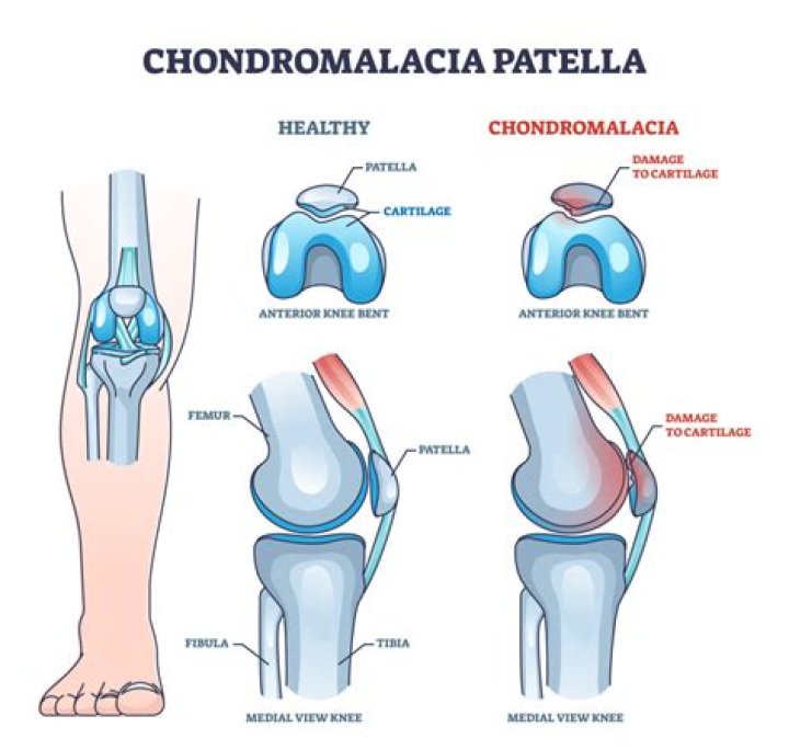 Does chondromalacia patella heal?