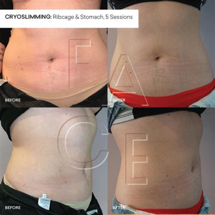 Does cryo fat freezing work?
