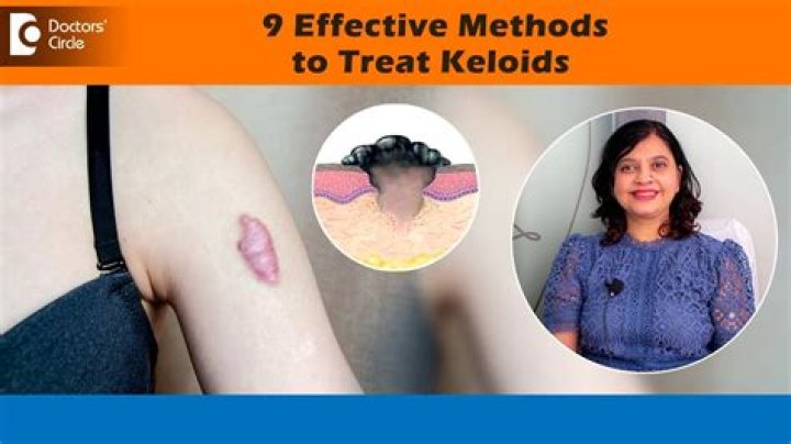 Does emu oil help keloids?