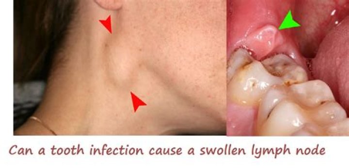 Does gingivitis cause swollen lymph nodes?