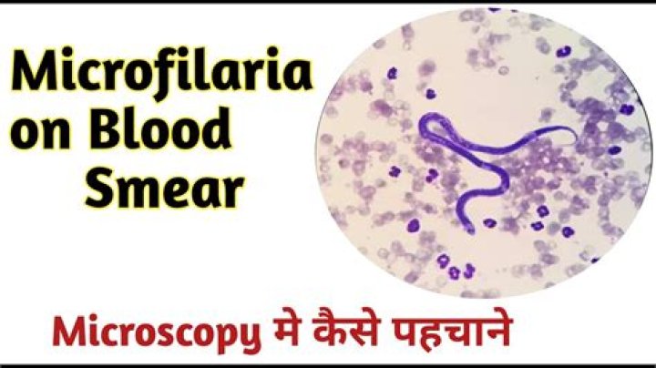 Does microfilaria cause itching?