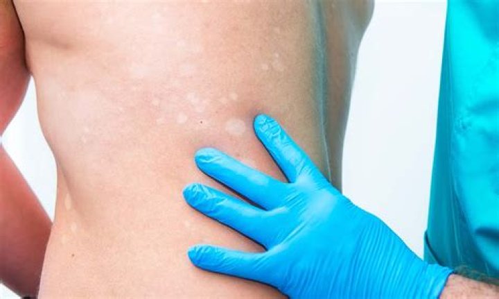 Does mollaret's meningitis go away?