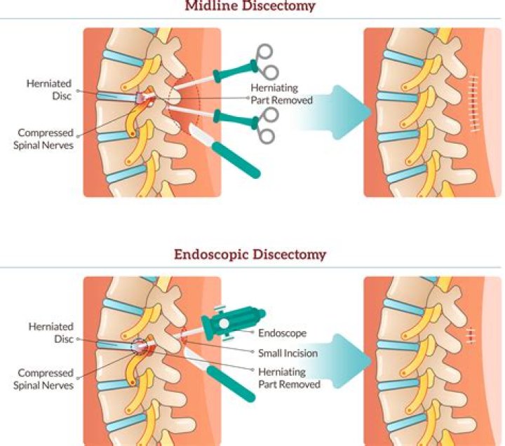 Does subacromial decompression work?
