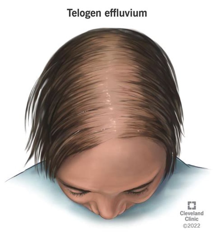 Does telogen effluvium get worse before it gets better?