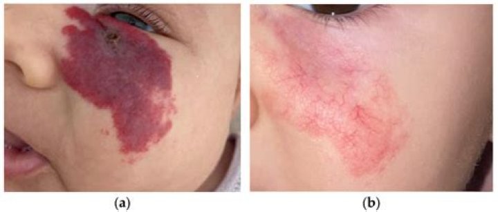 Does timolol work for hemangiomas?