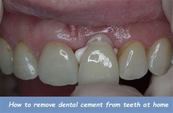 How do you remove cement from teeth?