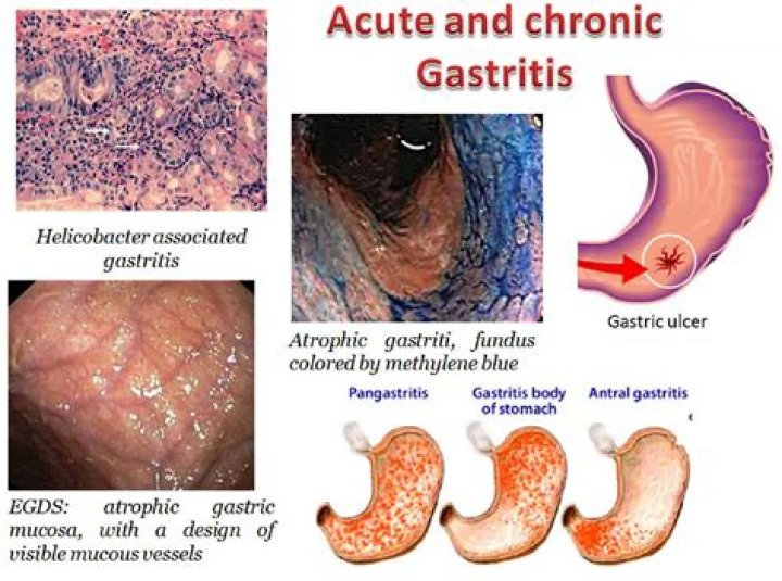 How gastritis is caused?
