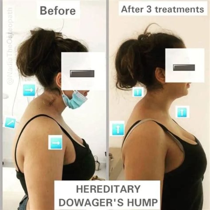 How is dorsal hump removal done?
