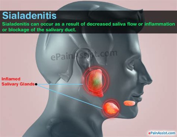 How is sialadenitis diagnosed?