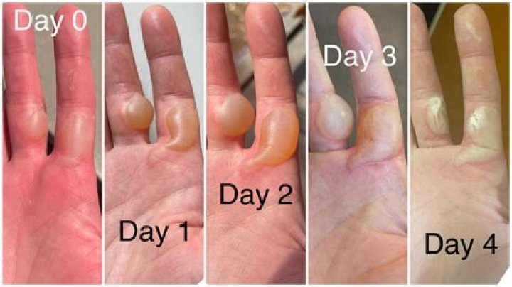 How long do blisters last?