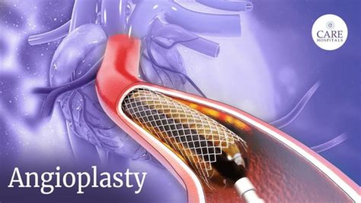How long does an angioplasty take?