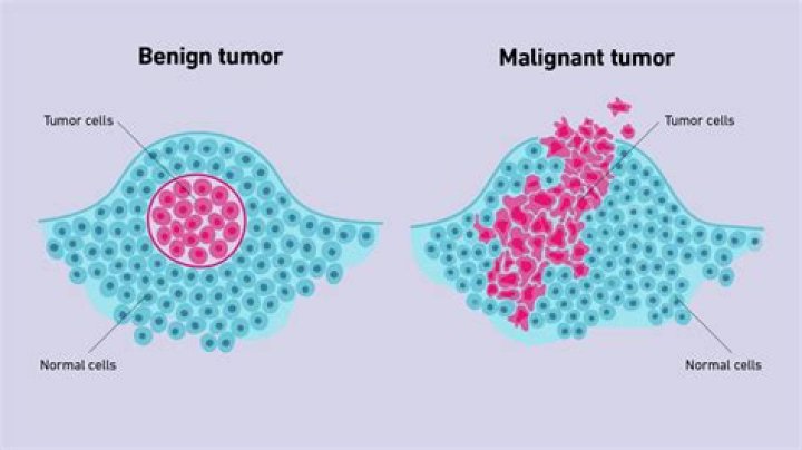 How malignant tumors spread?