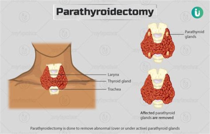 How much does parathyroidectomy cost?