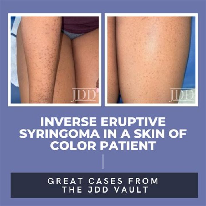 How to prevent eruptive syringoma?