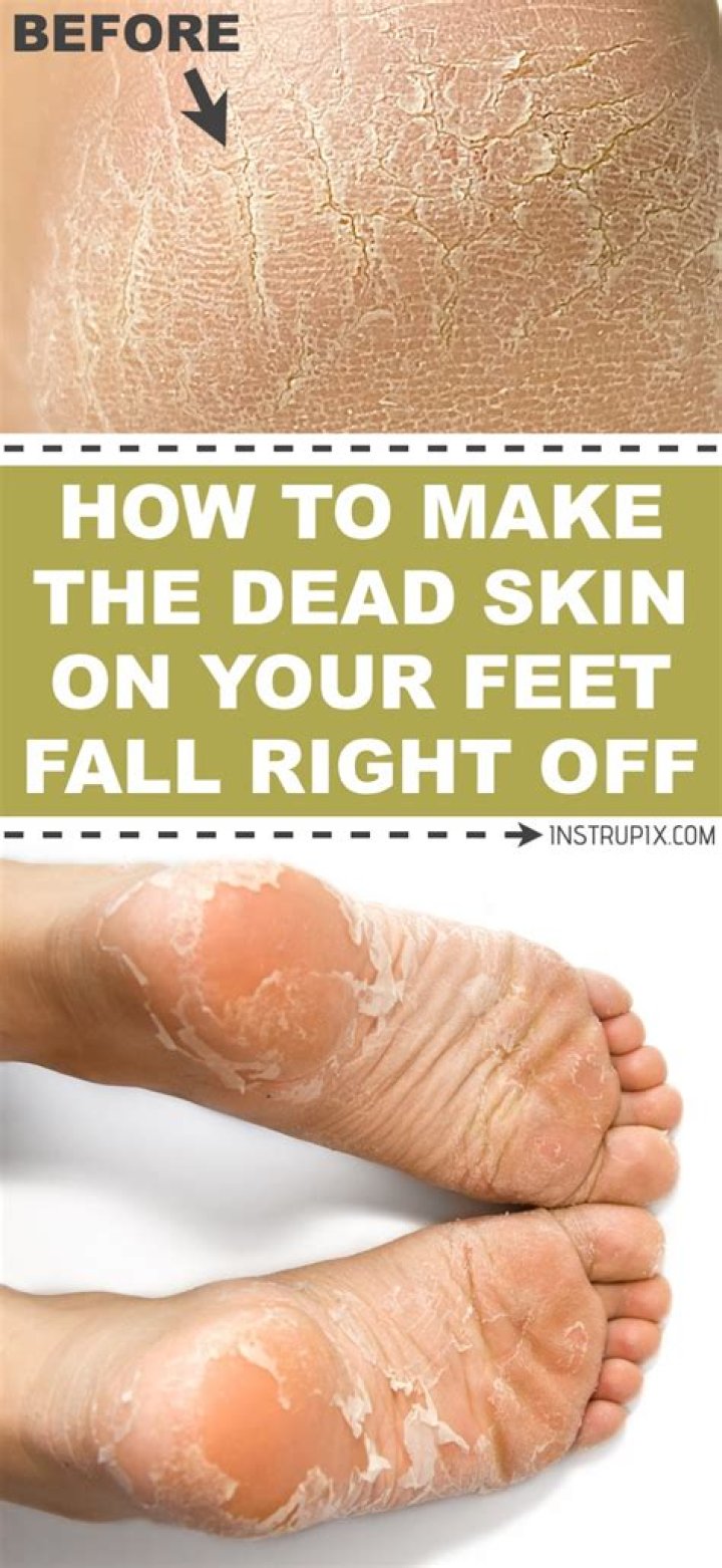 How to soak dead skin off feet?