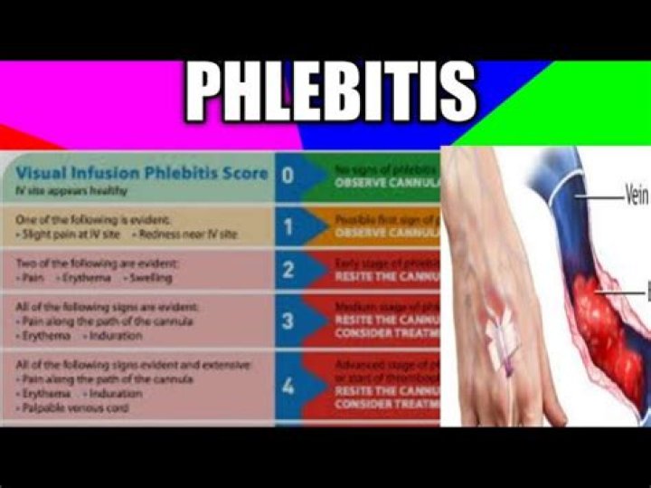 How to treat phlebitis of iv site?