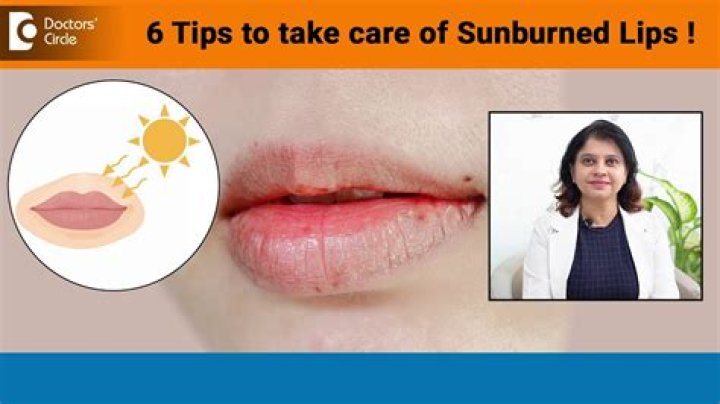 How to treat sun blistered lips?