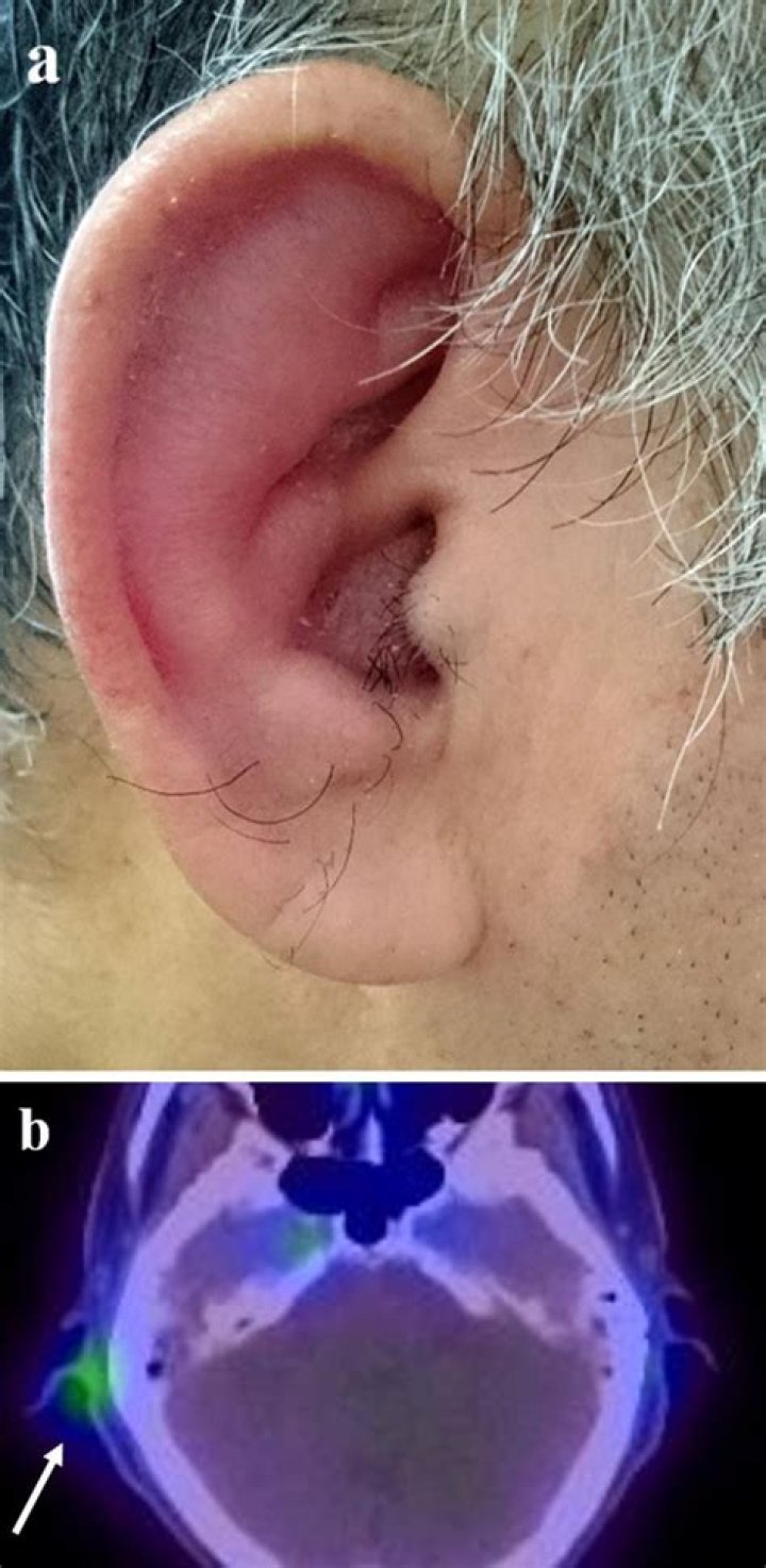 In front of ear swelling?