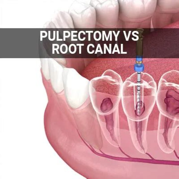 Is a pulpectomy the same as a root canal?