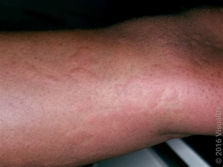 Is it welts or whelps?