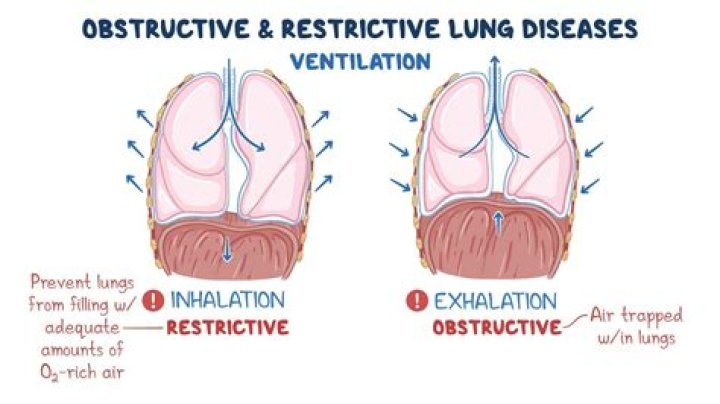 Is obstructive ventilatory defect?