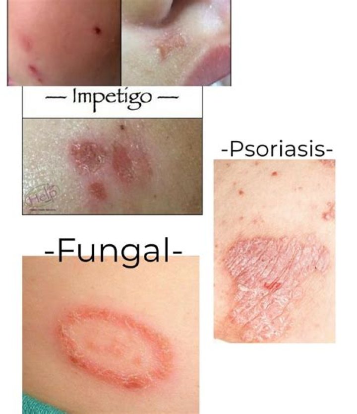 Is psoriasis a fungus?