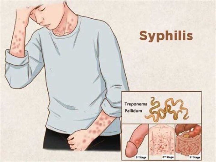 Is syphilis a sexually transmitted disease?