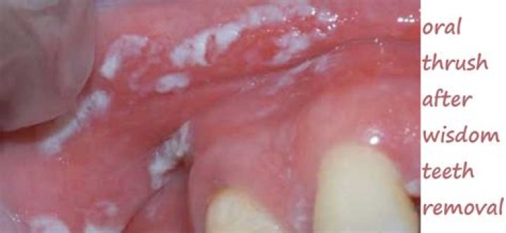 Should i be worried about oral thrush?
