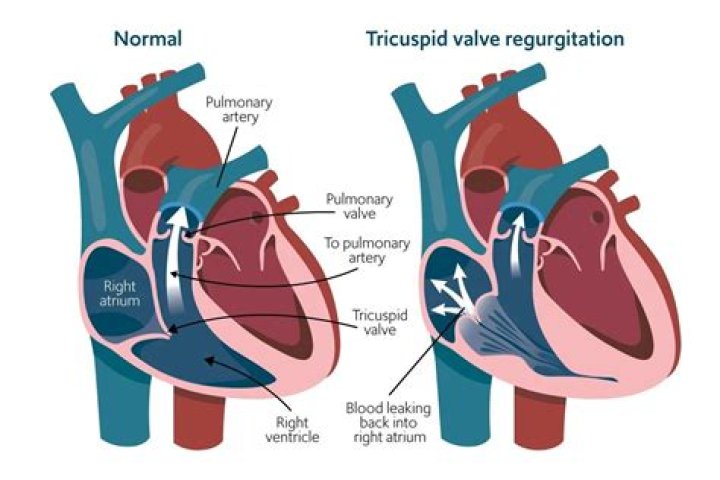 Should i worry about moderate tricuspid valve regurgitation?