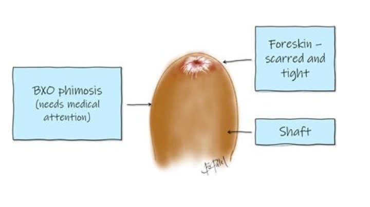Should pulling back foreskin hurt?