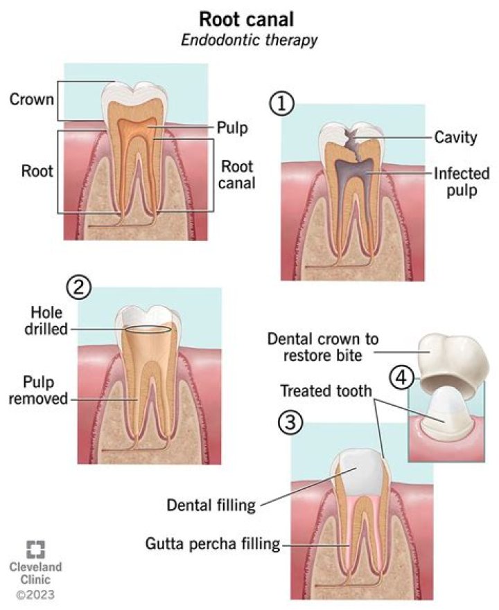 Should root canal be done before crown?